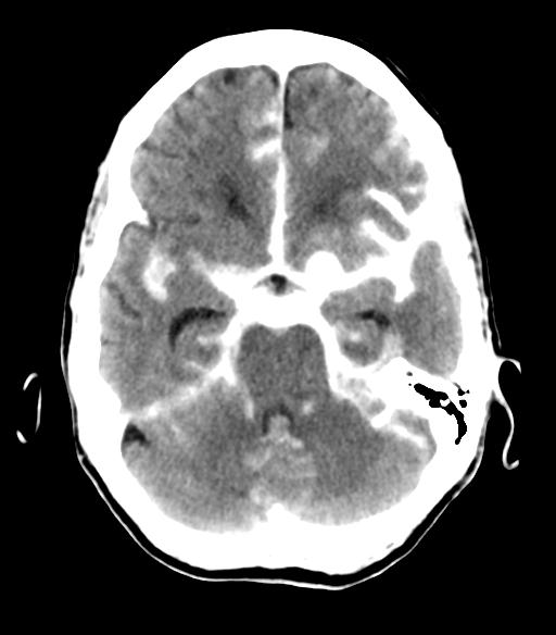 File:Cerebral aneurysm with rupture (Radiopaedia 29933-30460 Axial non-contrast 9).jpg