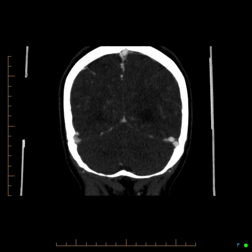 Cerebral arteriovenous malformation (AVM) (Radiopaedia 78162-90706 Coronal CTA 27).jpg