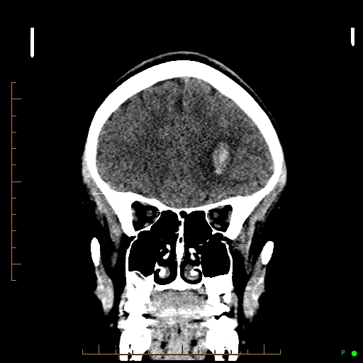 File:Cerebral arteriovenous malformation (AVM) (Radiopaedia 78162-90706 Coronal non-contrast 29).jpg