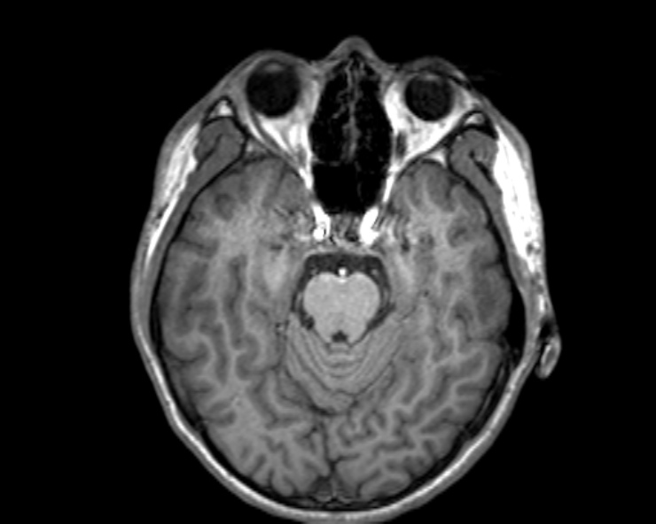 Cerebral arteriovenous malformation (Radiopaedia 30198-30813 Axial T1 40).jpg