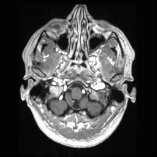 File:Cerebral arteriovenous malformation (Radiopaedia 39259-41506 AX T1 MPR C+ 8).png