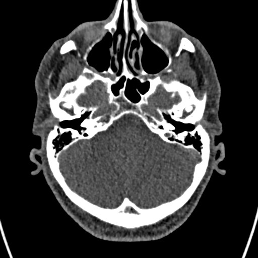 Cerebral arteriovenous malformation (Radiopaedia 78188-90746 Axial non-contrast 39).jpg