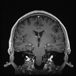 Cerebral arteriovenous malformation (Radiopaedia 84015-99245 Coronal T1 C+ 82).jpg