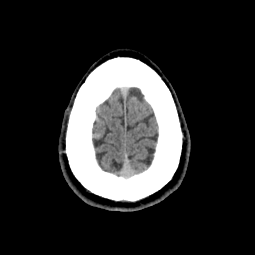 Cerebral arteriovenous malformation (Spetzler-Martin grade 2) (Radiopaedia 41262-44076 Axial non-contrast 50).png