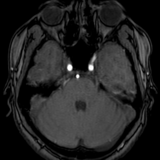 Cerebral arteriovenous malformation at posterior body of corpus callosum (Radiopaedia 74111-84925 Axial MRA 54).jpg