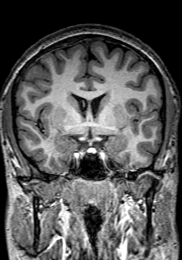 Cerebral arteriovenous malformation at posterior body of corpus callosum (Radiopaedia 74111-84925 Coronal T1 137).jpg
