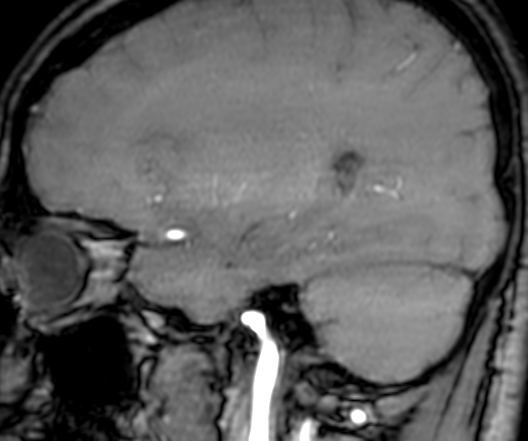 File:Cerebral arteriovenous malformation at posterior body of corpus callosum (Radiopaedia 74111-84925 J 108).jpg