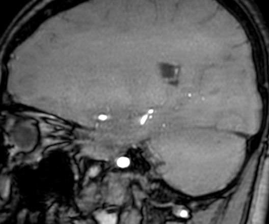 Cerebral arteriovenous malformation at posterior body of corpus callosum (Radiopaedia 74111-84925 J 130).jpg