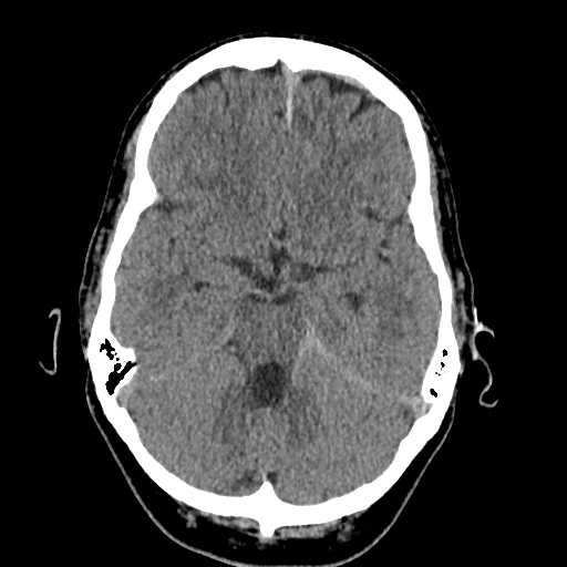 Cerebral arteriovenous malformation with lobar hemorrhage (Radiopaedia 35598-37117 Axial non-contrast 17).jpg