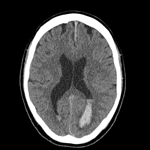 Cerebral arteriovenous malformation with lobar hemorrhage (Radiopaedia 35598-37117 Axial non-contrast 32).jpg