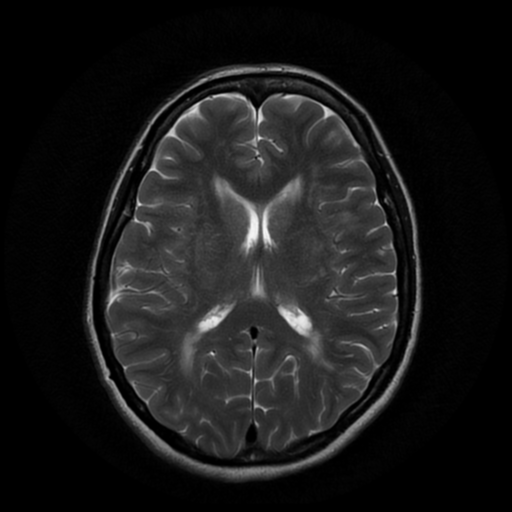 File:Cerebral autosomal dominant arteriopathy with subcortical infarcts and leukoencephalopathy (CADASIL) (Radiopaedia 41018-43768 Ax T2 PROP 12).png