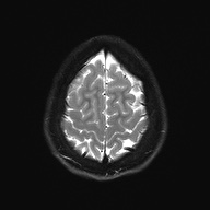 Cerebral cavernous venous malformation (Radiopaedia 70008-80021 Axial DWI 27).jpg