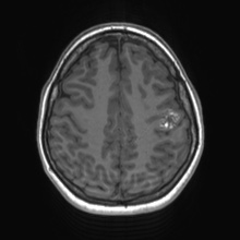 File:Cerebral cavernous venous malformation (Radiopaedia 70008-80021 Axial T1 61).jpg