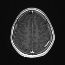 Cerebral cavernous venous malformation (Radiopaedia 70008-80021 Axial T1 C+ 76).jpg