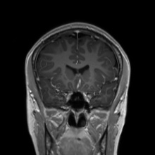 Cerebral cavernous venous malformation (Radiopaedia 70008-80021 Coronal T1 C+ 41).jpg