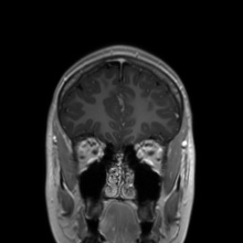 File:Cerebral cavernous venous malformation (Radiopaedia 70008-80021 Coronal T1 C+ 49).jpg