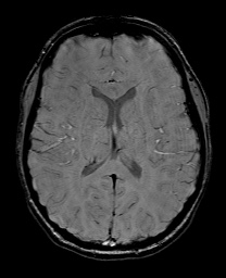 Cerebral cavernous venous malformation (Radiopaedia 70008-80021 I 42).jpg