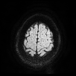 Cerebral cavernous venous malformation (Zabramski type II) (Radiopaedia 85511-101198 Axial DWI 60).jpg