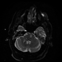 Cerebral embolic infarcts (embolic shower) (Radiopaedia 49837-55108 Axial DWI 36).jpg