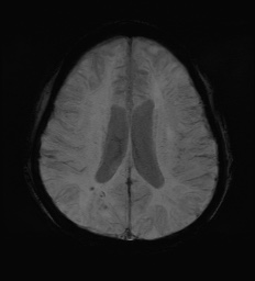 Cerebral embolic infarcts (embolic shower) (Radiopaedia 72391-82921 Axial SWI 47).jpg