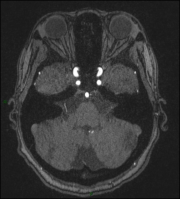 Cerebral fat embolism (Radiopaedia 35022-36525 Axial TOF 45).jpg
