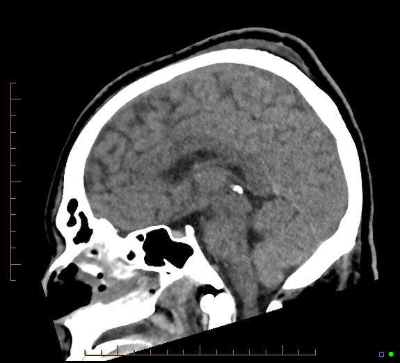 Cerebral fat embolism (Radiopaedia 85521-101224 C 27).jpg