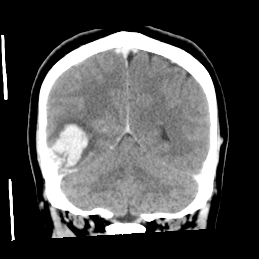 Cerebral hemorrhage secondary to arteriovenous malformation (Radiopaedia 33497-34561 C 48).png