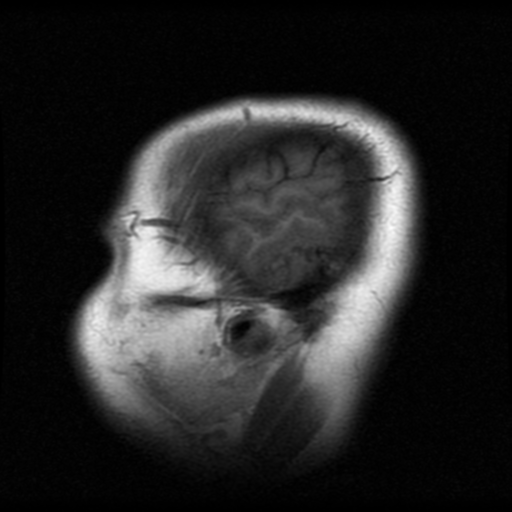 File:Cerebral hemorrhage secondary to arteriovenous malformation (Radiopaedia 33497-34572 Sagittal T1 21).png