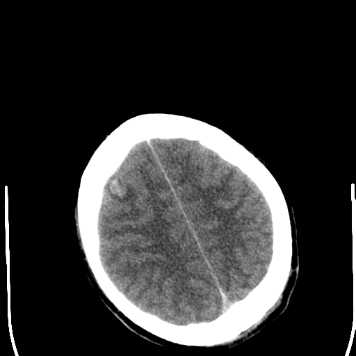 File:Cerebral hemorrhagic contusions- temporal evolution (Radiopaedia 40224-42752 Axial non-contrast 23).png