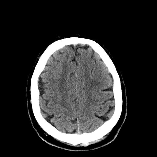 File:Cerebral hemorrhagic contusions and cervical spine fractures (Radiopaedia 32865-33841 Axial non-contrast 27).jpg