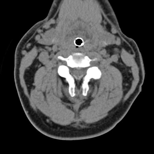 Cerebral hemorrhagic contusions and cervical spine fractures (Radiopaedia 32865-33841 F 23).jpg