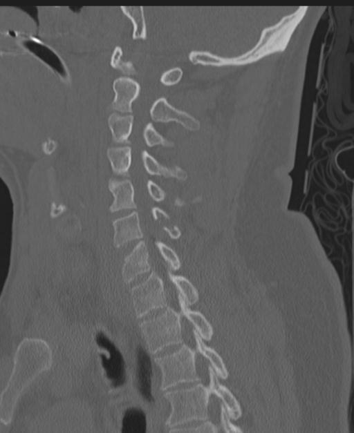 Cerebral hemorrhagic contusions and cervical spine fractures (Radiopaedia 32865-33841 Sagittal bone window 58).jpg