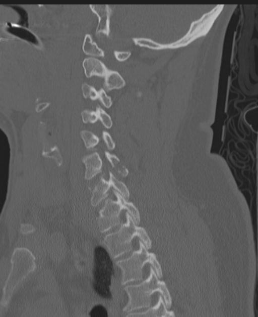 Cerebral hemorrhagic contusions and cervical spine fractures (Radiopaedia 32865-33841 Sagittal bone window 60).jpg