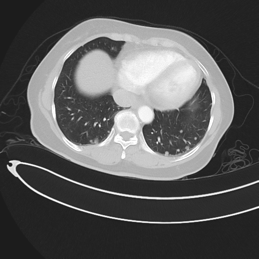 Cerebral metastases (Radiopaedia 33041-34055 Axial lung window 41).png