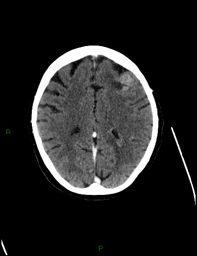 Cerebral metastases - ependymal and parenchymal (Radiopaedia 79877-93131 Axial C+ delayed 57).jpg