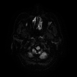 Cerebral metastases - melanoma (Radiopaedia 80972-94522 Axial DWI 4).jpg