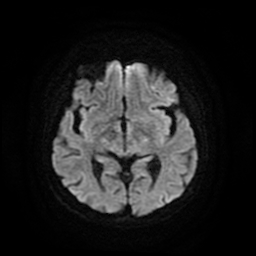 Cerebral metastases - melanoma (Radiopaedia 80972-94522 Axial DWI 47).jpg