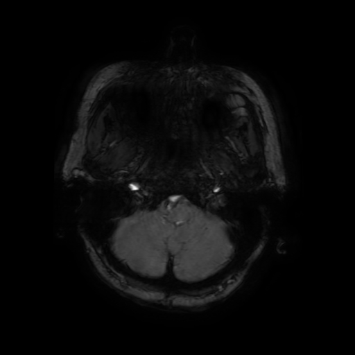 Cerebral metastases - melanoma (Radiopaedia 80972-94522 Axial SWI 15).jpg