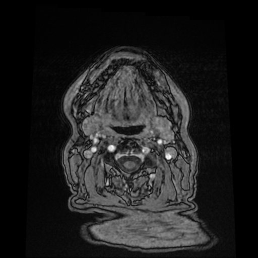 Cerebral metastases - melanoma (Radiopaedia 80972-94522 Axial T1 C+ 2).jpg
