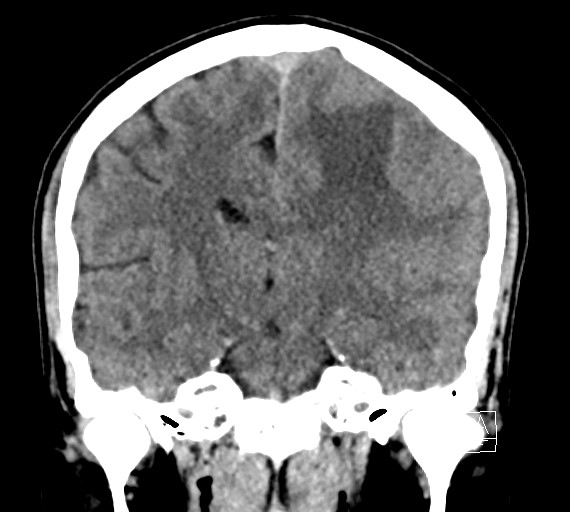 Cerebral metastases - testicular choriocarcinoma (Radiopaedia 84486-99855 Coronal C+ delayed 34).jpg