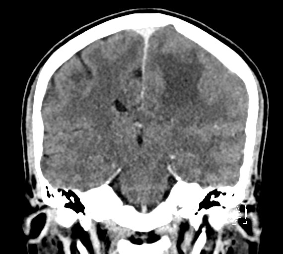 Cerebral metastases - testicular choriocarcinoma (Radiopaedia 84486-99855 D 35).jpg