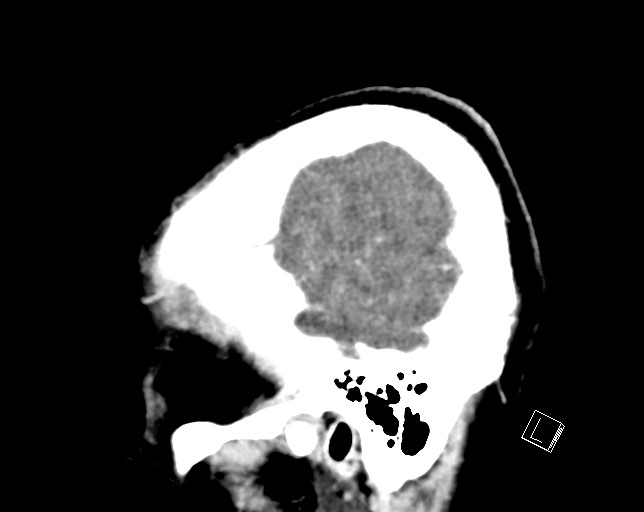 Cerebral metastases - testicular choriocarcinoma (Radiopaedia 84486-99855 F 10).jpg