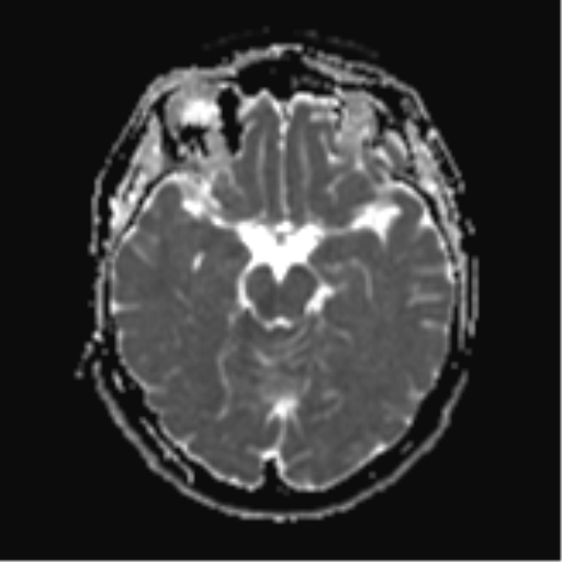 File:Cerebral metastases mimicking abscesses (Radiopaedia 45841-50131 Axial ADC 12).png