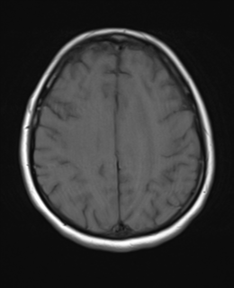 File:Cerebral metastases mimicking abscesses (Radiopaedia 45841-50131 Axial T1 20).png