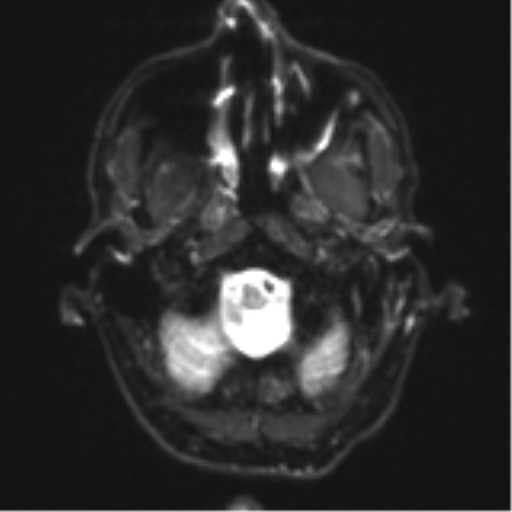 Cerebral metastasis - melanoma (Radiopaedia 54718-60954 Axial DWI 4).png