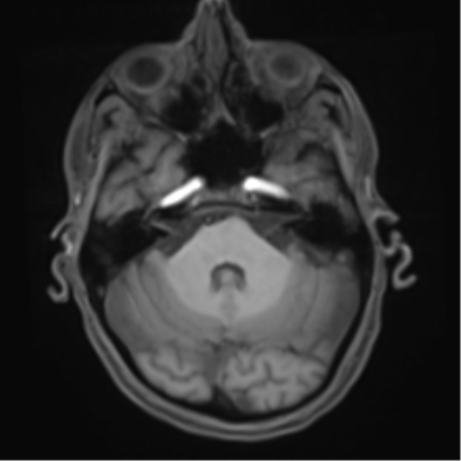 File:Cerebral metastasis - melanoma (Radiopaedia 54718-60954 Axial T1 15).png