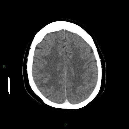 File:Cerebral metastasis from renal cell carcinoma (Radiopaedia 82306-96375 Axial C+ delayed 27).jpg