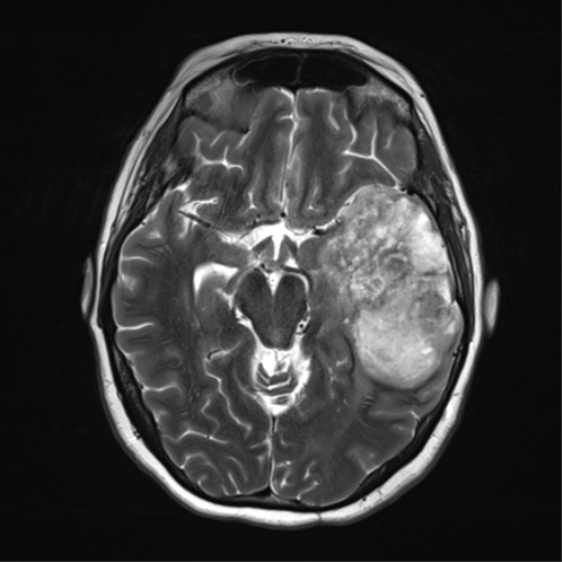 File:Cerebral metastasis mimicking glioblastoma (Radiopaedia 69155-78937 Axial T2 17).png
