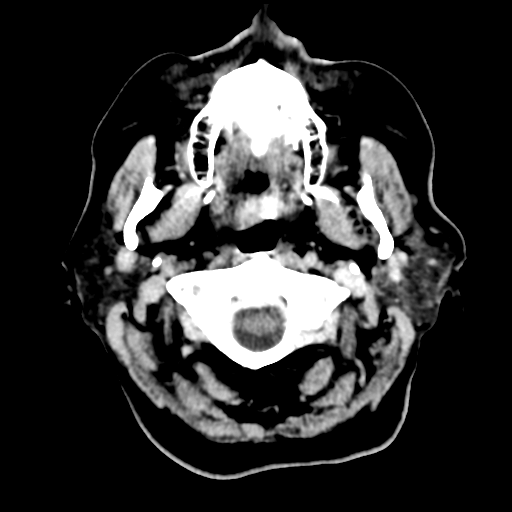 Cerebral metastasis to basal ganglia (Radiopaedia 81568-95412 Axial C+ delayed 6).png
