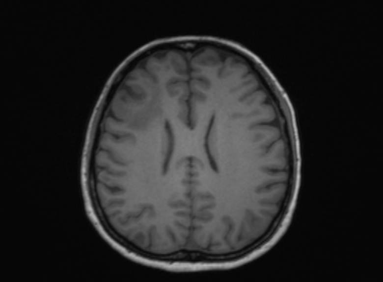 Cerebral ring enhancing lesions - cerebral metastases (Radiopaedia 44922-48817 Axial T1 189).jpg
